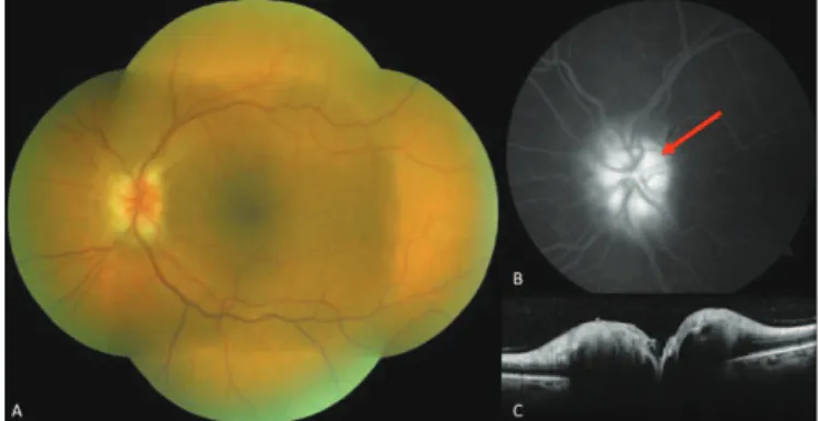 Figure 3: A – Normal left eye retinography; B – Late phase angiography without leakage or staining; C – Spectralis OCT: decrease of the retinal thickness around the optic nerve (yellow arrows)