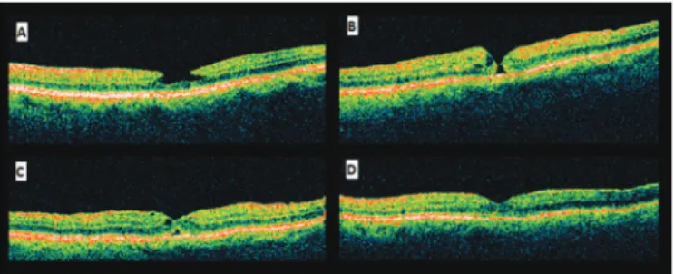 Figure 3: Retinography (A) and OCT (B) after 1 year of follow-up Figure 2: Three weeks after PPV (A), full-thickness MH; 7 weeksafter PPV (B), spontaneous closure of the MH
