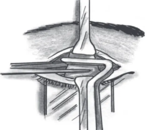 Figure 2. Frontalis suspension. The arrow indicates the point where the sling material ends are joined together at the head of the eyebrow.