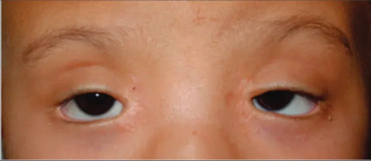 Figure 3. Blepharophimosis. Note the marks of epicanthus inversus correction. Severe ptosis with arched eyebrows, reduced horizontal fissure, and euryblepharon.