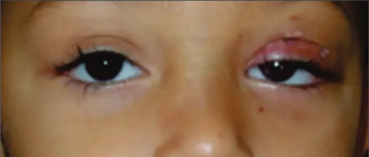 Figure 4. Under-correction of left ptosis 15 days after resection of the LPS aponeurosis.
