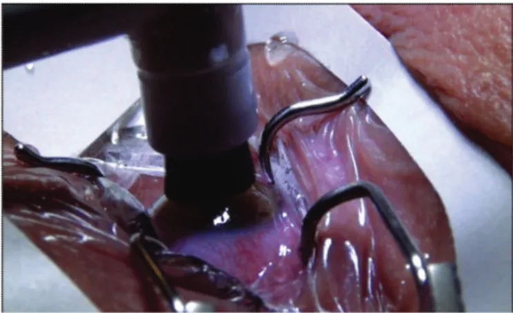 Figure 1: Manual de-epithelialisation with a straight, round-tip crescent
