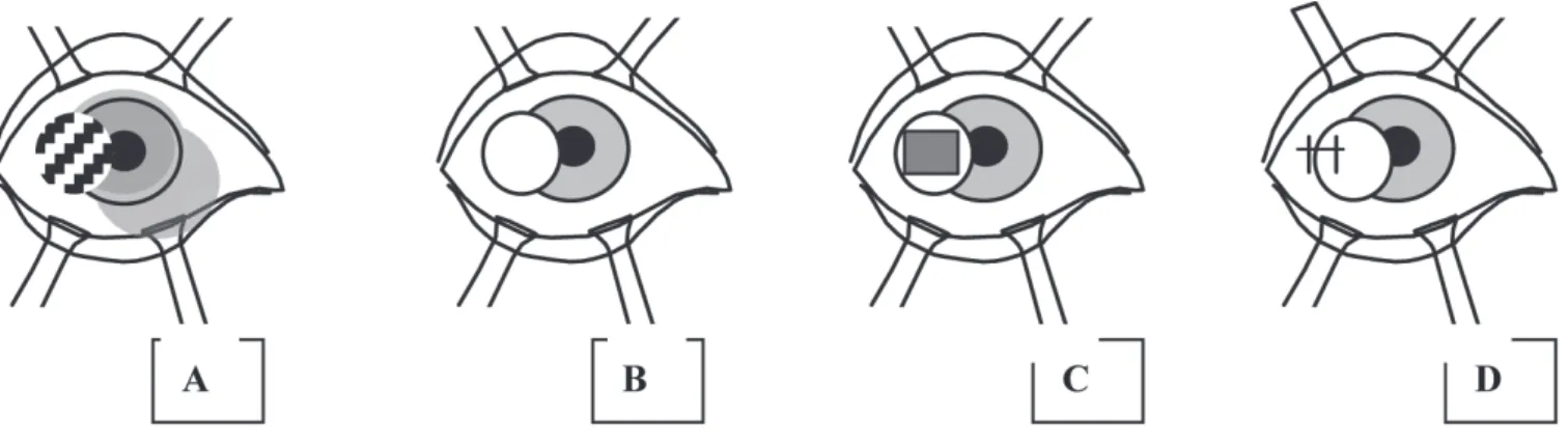 Figure 1. A) 8.0-mm optical zone marker positioned in the temporal limbus of the right eye; B) The marked area, with the de-epithelialised cornea and the exposed episcleral area; C) The Weck-Cel sponge soaked in solution is applied to the episclera; D) The