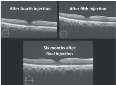 Figure 2: Partial improvement of cystoid macular oedema after the first injection, and image showing a relapse of oedema.