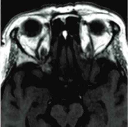 Figure 2C: Axial MRI 3 months later, without the filling defectCavernous sinus thrombosis