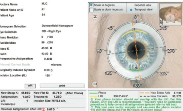 Figure 1: Example of toric IOL surgical planning (http://