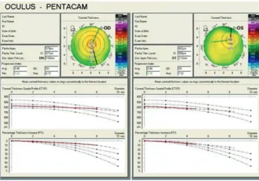 Figure 2. Specular microscopy Figure 3. Spatial pachymetric progression curve 12  showing a straightened pattern
