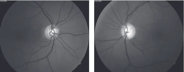 Figure 1. Fundus images showing a normal optic disc with cupping of 0.6 x 0.7 in the right eye and a pale optic disc with cupping of 0.8 x 0.9 in the left eye