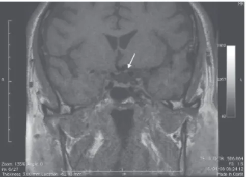 Figure 3. MRI showing contact between the internal carotid artery and the left optic nerve and elevation of the optic chiasm (white arrows)