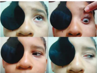 Figure 1. Facial asymmetry, enophthalmos and hypotropia on the left; gaze restriction.
