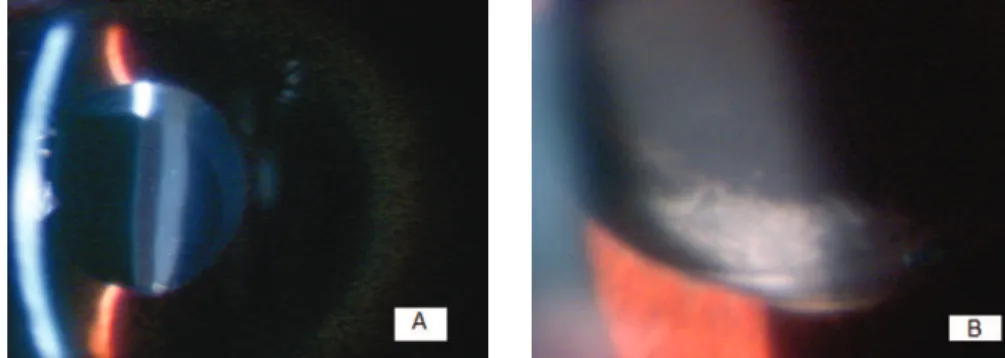 Figure 1: A. Large amount of white fluid trapped behind the intraocular lens. The tortuous aspect of the anterior and posterior line of the fluid is due to the irregular corneal surface;