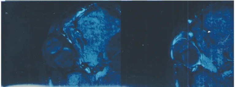 Figure 3. MRI examination of the right orbit with cavernous hemangiomaTumor of orbit