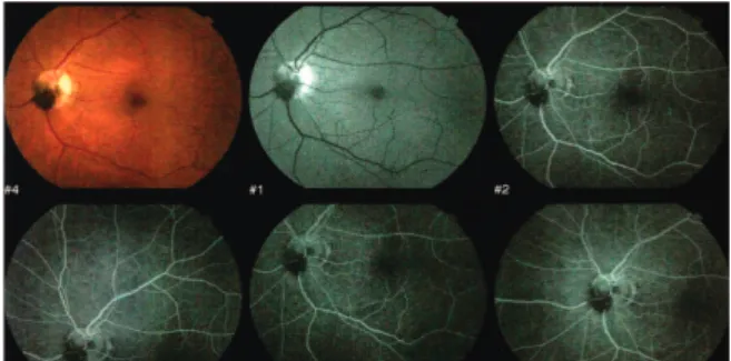 Figure B: Fluorescein angiography showed blockage of fluorescence in the topography of melanocytoma at all times.