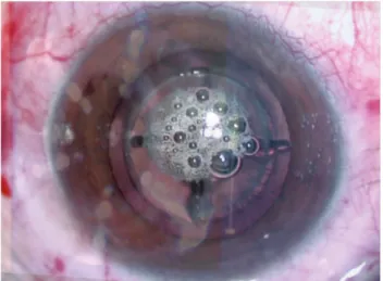 Figure 3. Postoperative: a) incisions were not completely linear and showed some irregularities; b) the capsulotomy was perfect