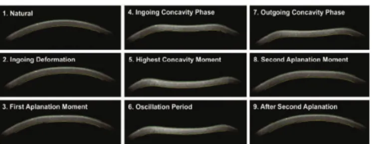 Figure 2. Dinamic view of the corneal deformation process. Stages of the examination of Corvis Scheimpflug Technology