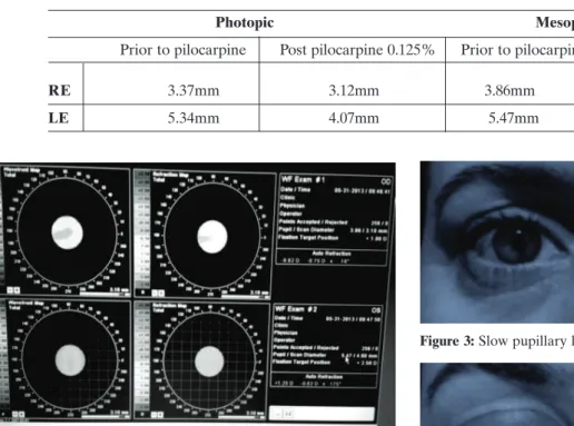 Figure 2: Normal pupillary light reflex of the right eye