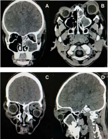 Figure 2.  A-D: Face CT in the axial, coronal and sagittal cuts, where there is exophthalmos of the left eyeball, opacification of paranasal sinuses and hyperdense image in the upper left part of the orbit suggestive of content arising from infection and t