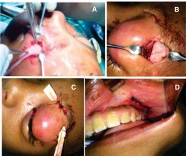 Figure 3 D – Suture held after draining through Cadwell Luc access of the left maxillary sinus.
