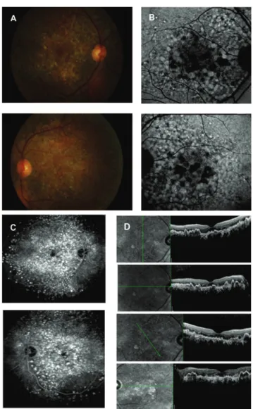 Figure 1: (A)The color photograph shows a yellow macular lesion surrounded by multiple soft drusen in both eyesand elevated in right eye.The FA shows early hyperfluorescence and late stainning (B)The SD-OCT shows a DPED with a pocket of associated subretin