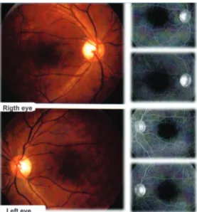 Figure 4: OCT images from 2011. Presence of foveal cysts in both eyes