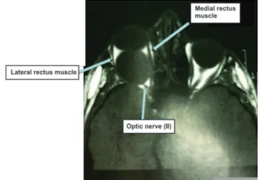 Figure 2: Pre-contrast axial section weighted in T1 showing isosignal of mass lesion, leading to proptosis of the RE