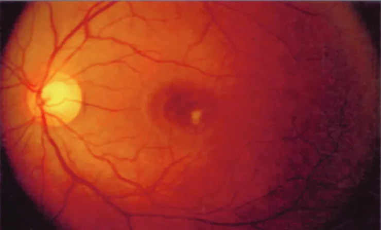 Figure 2: Regression of the lesion after antituberculous therapy for 6 months .