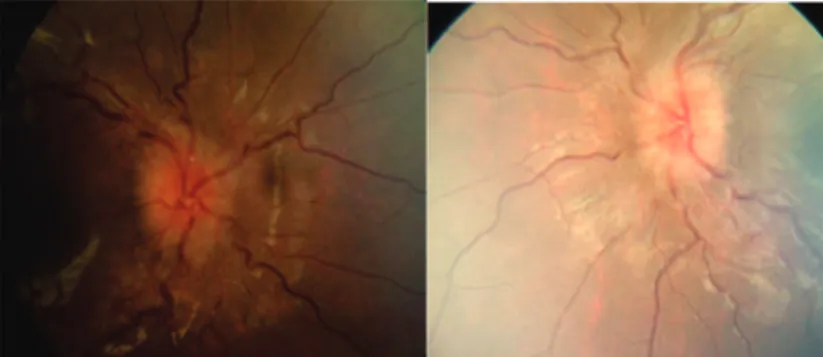 Figure 2: NMR angiography - subtraction image within the right sigmoid sinus