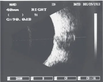 Figure 3. B-scan ultrasonography of the patient’s right eye identified the optic disc drusen