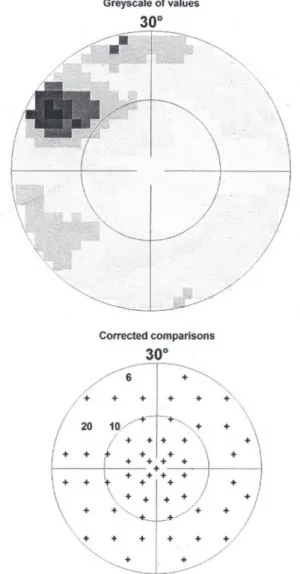 Figure 5. Optical coherence tomography (OCT) of the right eye showing the disorder of the retinal pigment epithelium near the macula.