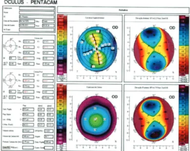 Figure 1: Preoperative tomography of the RE (composite elevation map of the anterior, posterior, sagittal curvature, and thickness of the cornea).