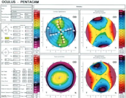 Figure 4: Postoperative tomography of the LE (composite elevation map of the anterior, posterior, sagittal curvature, and thickness of the cornea).