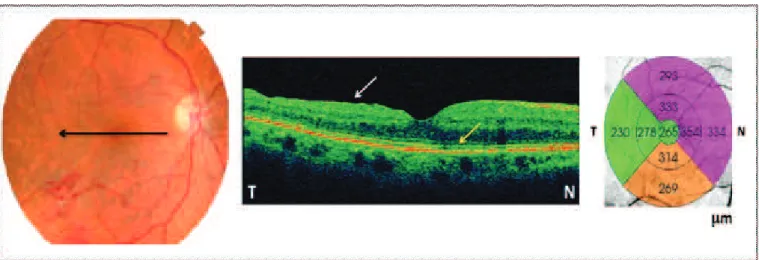 Figure 5: Case 4 – six weeks after treatment no subretinal blood on the macula was (is) observed (fundus retinography on the left); OCT scan (in the middle) showed mild irregularity in the contour of inner retina (white arrow) and almost complete absence o