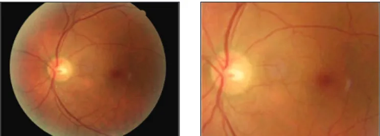 Figure 2: Color photos of drusen-like beneath retinal deposits in left eye, 2 years ago