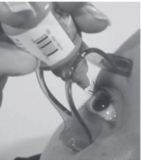 Figure 2: Instillation of drops with the facial support device