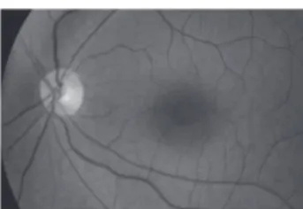Figure 2: Dot and fleck retinopathy. Subtle yellow fleck deposits can be seen in the macular area