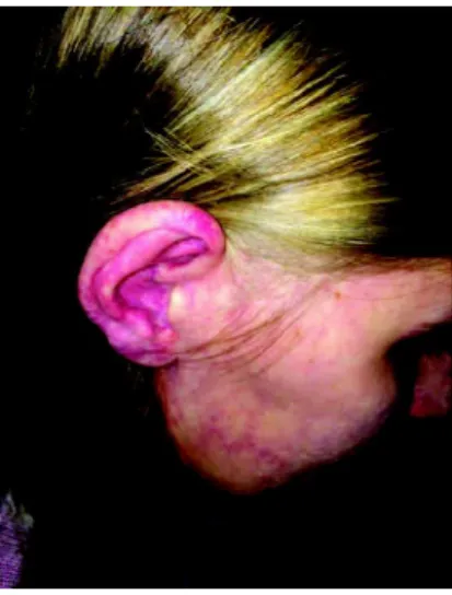 Figure 1C: Portwine stains on the right upper limb Source: The author (2015)