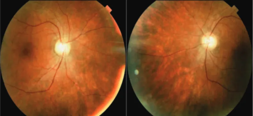 Figure 1:  Fundus examination: diffuse retinal pigment epithelium฀