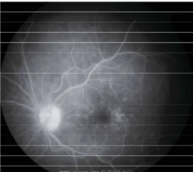 Figure 2:  Fluorescein angiogram in the left eye showing small areas of hyperfluorescence in the macula
