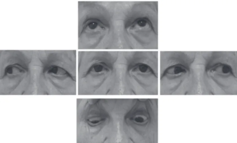 Figure 1: Versions of the patient:Right hipertropia in primary position, with worsening in depression and limitation of elevation, without restriction.