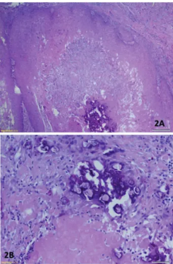 Figure 2: A - Epithelial neoplasm with areas of calcification (HE 40x). B - Details showing areas of calcification and ghost cells (HE 200x).