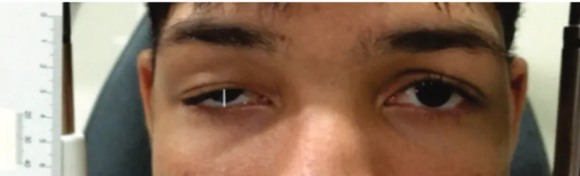 Figure 4: Patient with severe ptosis: pre and postoperative appearance.