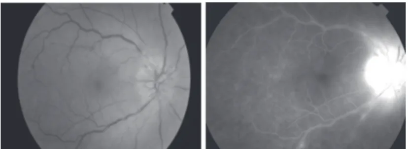 Figure 5: Segmental papillitis and periphlebitis (retinography and angiography)