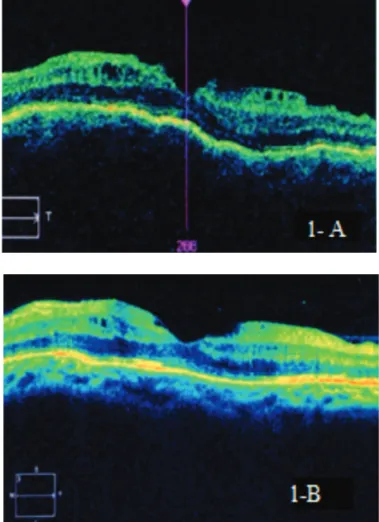 Figure 1: a) OCT showing accumulation of subretinal fluid, choroid folding compatible with hypotonic maculopathy