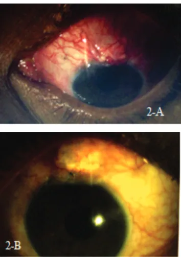 Figure 2: a) immediate postoperative period showing a formed chamber and an elevated bubble