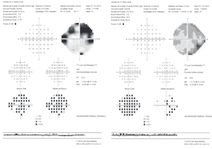 Figure 4: Visual field. 24-2. SITA strategy. Humphrey HFA-II (Carl Zeiss Meditec, Dublin, CA, USA)