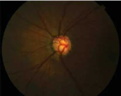 Figure 6 - Left eye fundus reveals excavation 0.9 with discreetly pale nerve in comparison to the right eye.
