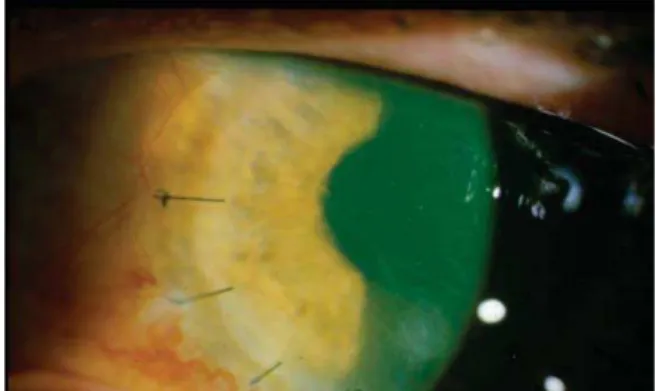 Figura 3:  Flap suture performed after the removal of epithelial cells at the interface region