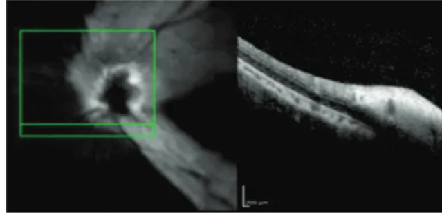 Figure 4: OCT left eye 