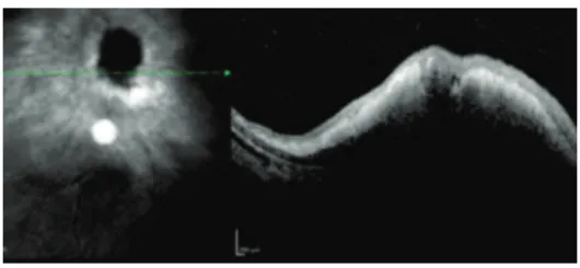 Figure 5: leukocoria right eye and left eye 