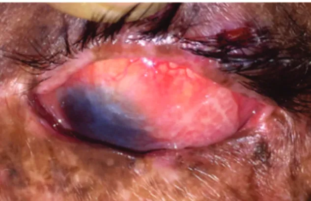 Figure 8.  Left eye lesion after 2 months of use of Interferon eyedrops